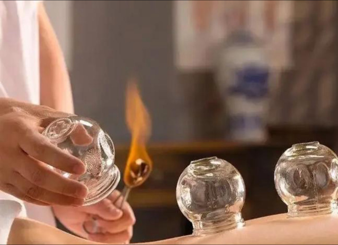 CuppingMassage